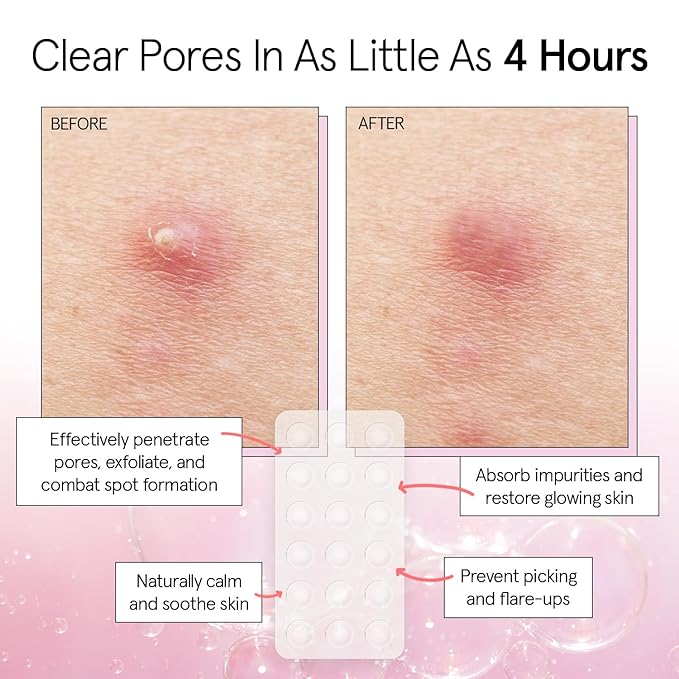 grace & stella Award Winning Multi-Size Pimple Patches for Face