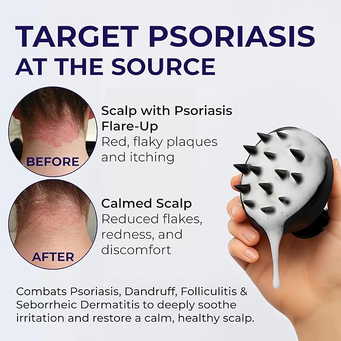 Psoriasis Shampoo Anti Dandruff - Medicated Shampoo for Dandruff, Flakes, Seborrheic Dermatitis & Folliculitis Treatment - Anti Fungal Solution for Itchy, Flaky & Dry Scalp - 200ml (Pack of 2)