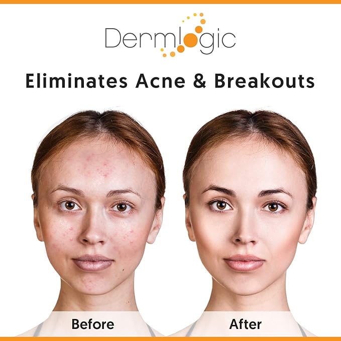 Dermlogic Acne Treatment Pads-Contains Glycolic, Lactic, Salicylic Acid. Eliminates Oily Skin, Clogged Pores & Cystic Breakouts. Removes Dark Spots, Whitehead & Blackhead Pimples for Face & Body.