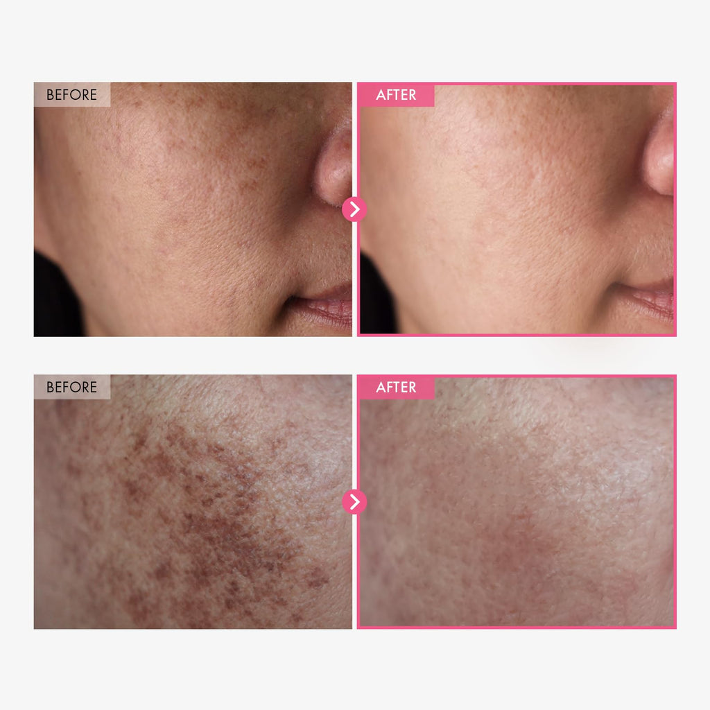 TOSOWOONG Arbutin 7% + Tranexamic Acid 4% Cream for Dark Spots, Brightening
