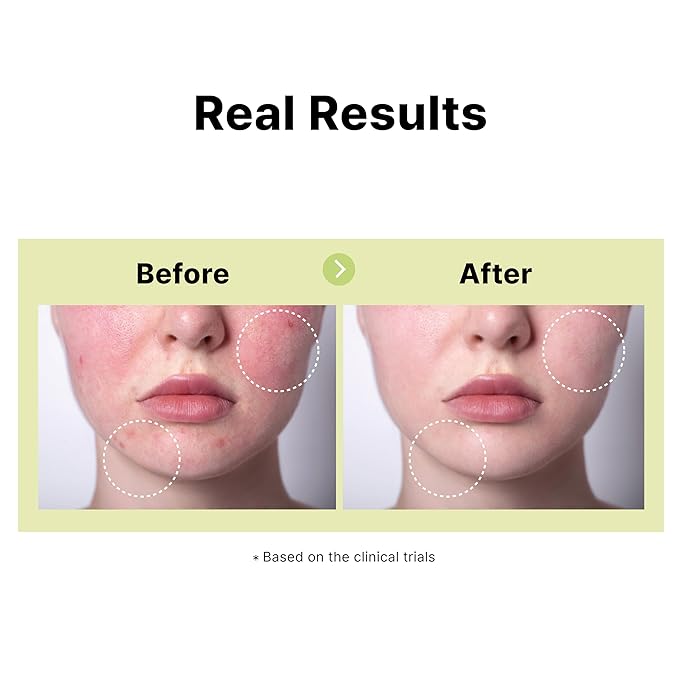 DearMYDEW 10% Azelaic Acid Serum with Niacinamide, Salicylic Acid, Allantoin, Rosacea Treatment for Face Redness Relief, Reduce Cystic Acne Scar, Pimples, Non-Comedogenic, Korean Skincare, 1Fl Oz