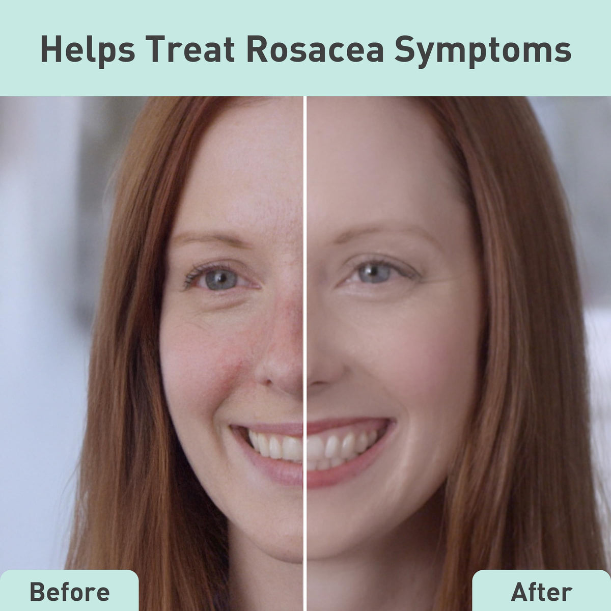PROcure Rosacare Redness Relief Sheet Mask 5-Pack - Hyaluronic Acid