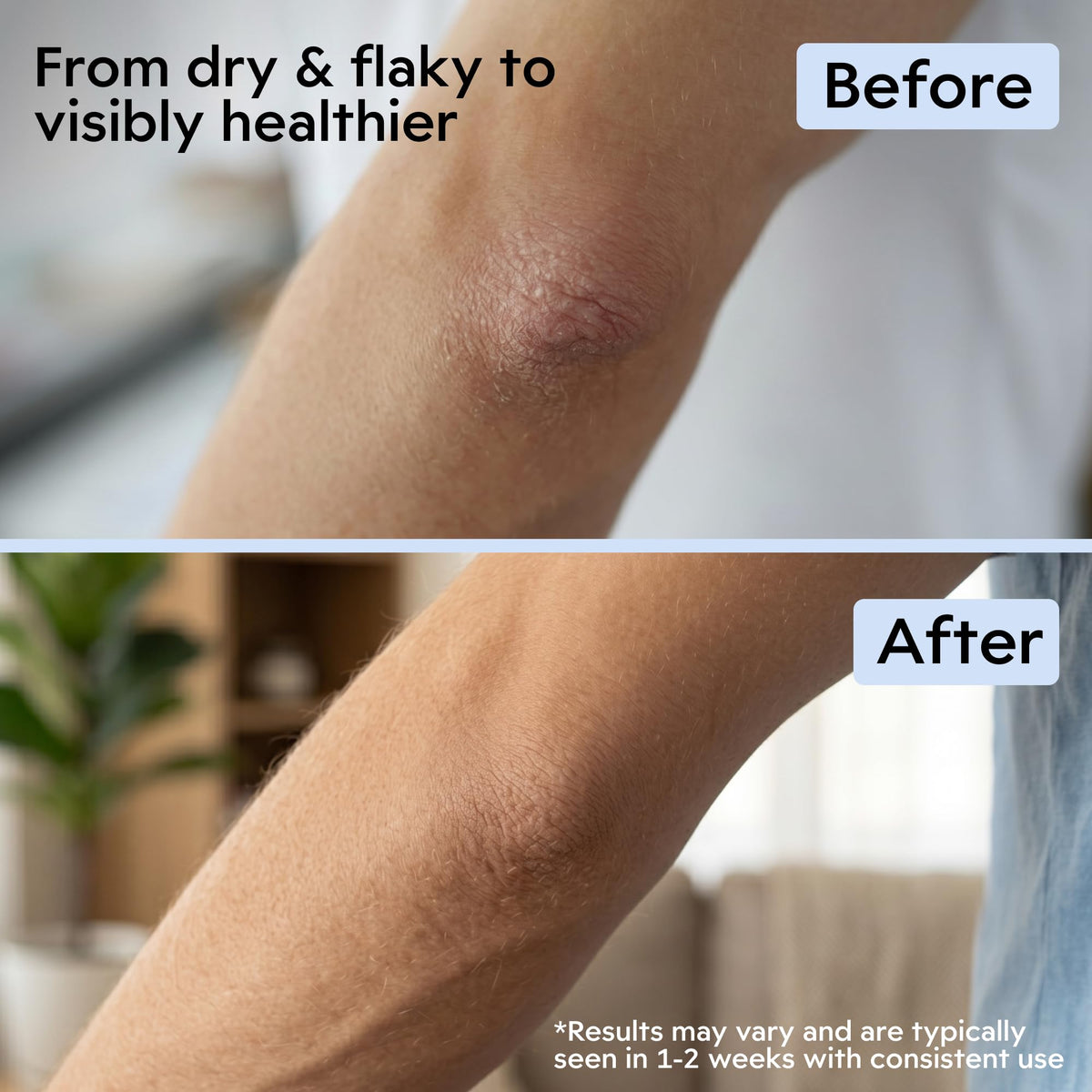 Clearbody Organics 2oz Manuka Honey Gel Eczema Cream with Colloidal Oatmeal