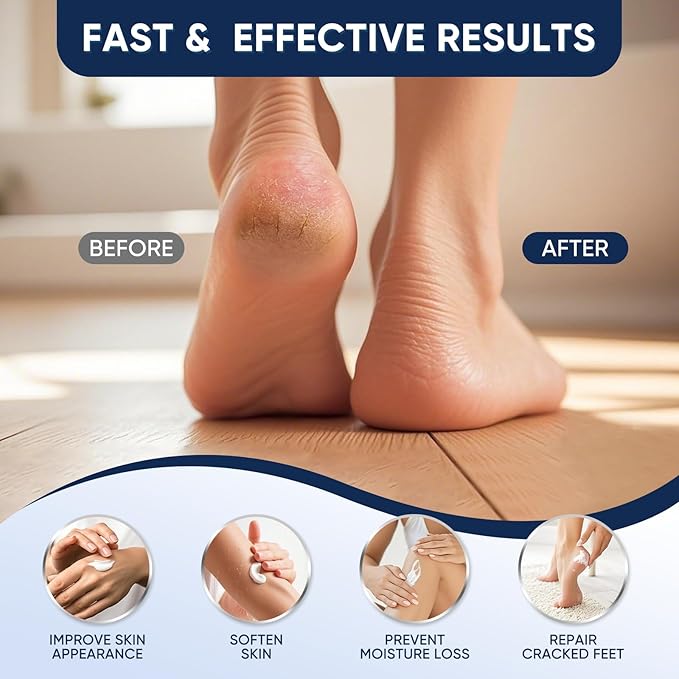 VREKEF Urea Cream 40 Percent with 2 Percent Salicylic Acid, Foot & Hand Cream for Dry Cracked Heels, Callus Softener for Feet, Exfoliating Foot Cream for Rough Thick Skin, 5.29 oz