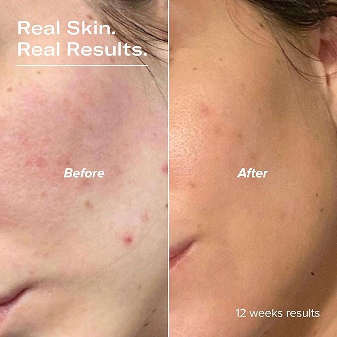 PLKYYLIH Serum Junkie Plump Hyaluronic Acid Serum with 5D Hyaluronic Complex, Ectoin, Plant Ceramides, Vitamin B5 and E, Deep Hydration, Strengthens and Supports Skin Barrier, Fragrance-Free, 1 fl oz