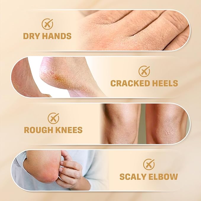 60% Urea Cream for Feet with 2% Salicylic Acid for Deep Hydration-150g