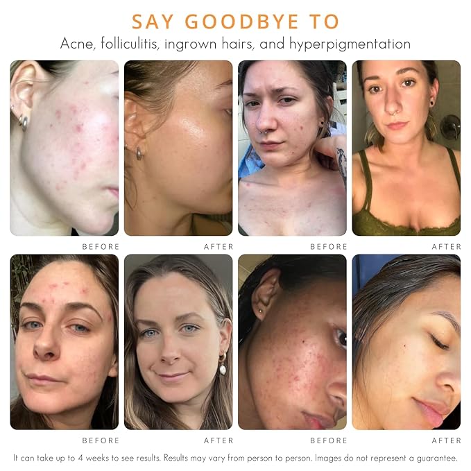 Almond Clear Mandelic Acid Face & Body Clearing Serum, Level 1- for acne, folliculitis, aging skin, ingrown hairs, dark spots - face, chest, butt, back, thighs, arms - 1 fl oz