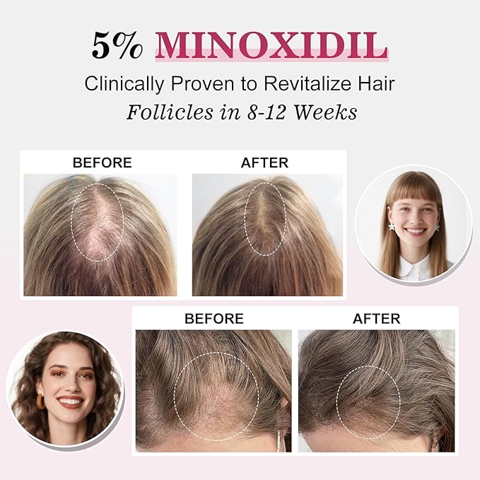 5% Minoxidil for Women Hair Regrowth Spray, hers hair regrowth treatment Infused
