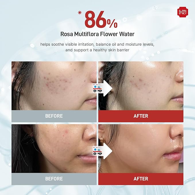 DERMAGENCY Zeroca 86 Toner | Korean Toner for Acne-Prone & Sensitive Skin | Lightweight, Fast-Absorbing | Oil Control, Pore Refining, Redness Relief | Fragrance-Free | K-Beauty 6.76 Fl.Oz 200ml