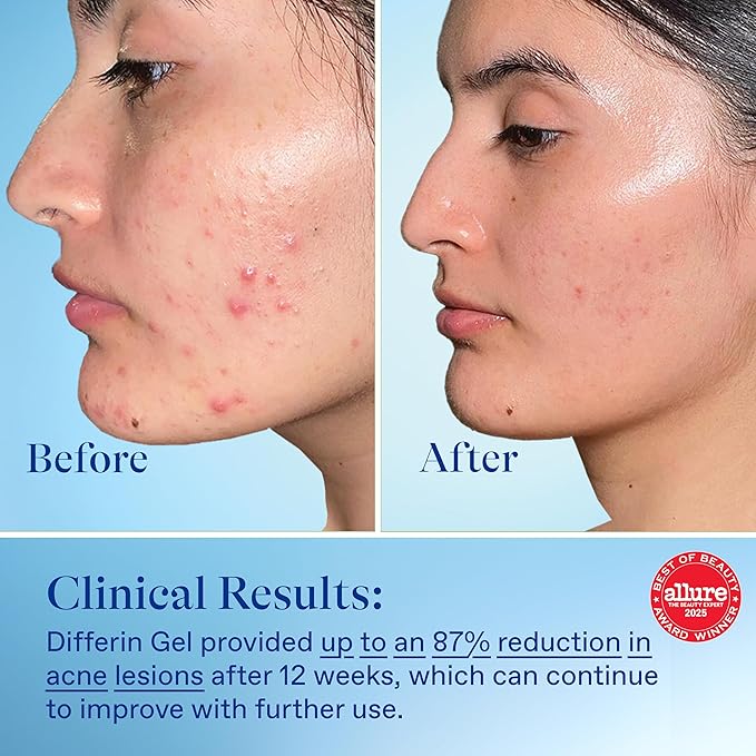 Differin Acne Retinoid Treatment Gel, 0.1% Adapalene, 15g Pump
