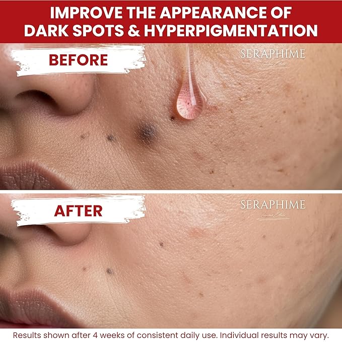 Seraphime Tranexamic Acid TXA 4% + Niacinamide 10% Serum – Discoloration Correcting Serum with Alpha Arbutin, Pro-Vitamin B5, Phloretin Dark Spot, Hyperpigmentation, Uneven Skin Tone Corrector 1 fl oz