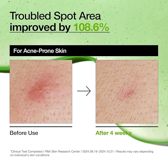 Anua Azelaic Acid 10 Hyaluron Redness Soothing Serum, Facial Serum for Blemish-Prone & Oily-Prone Skin, Lightweight & Hydrating Blemish Care, Hyaluronic Acid, Korean Skincare, 1.01 fl oz.
