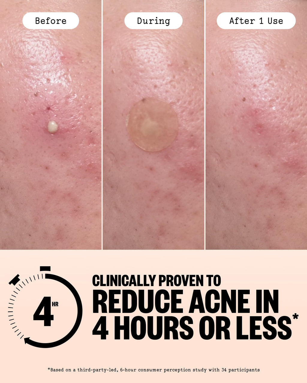 PEACE OUT Acne Healing Dots Hydrocolloid Pimple Patches (40 count)