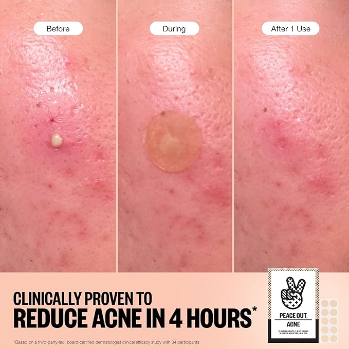 PEACE OUT Acne Healing Dots Hydrocolloid Pimple Patches (60 count)