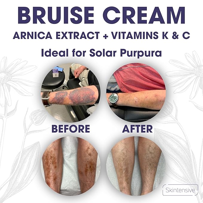 SKINTENSIVE Arnica Bruise Cream for Thin Skin – Vitamin K Cream for Bruises & Skin Discoloration, Moisturizing Arnica Cream for Seniors, Non-Greasy Formula, 4 Oz