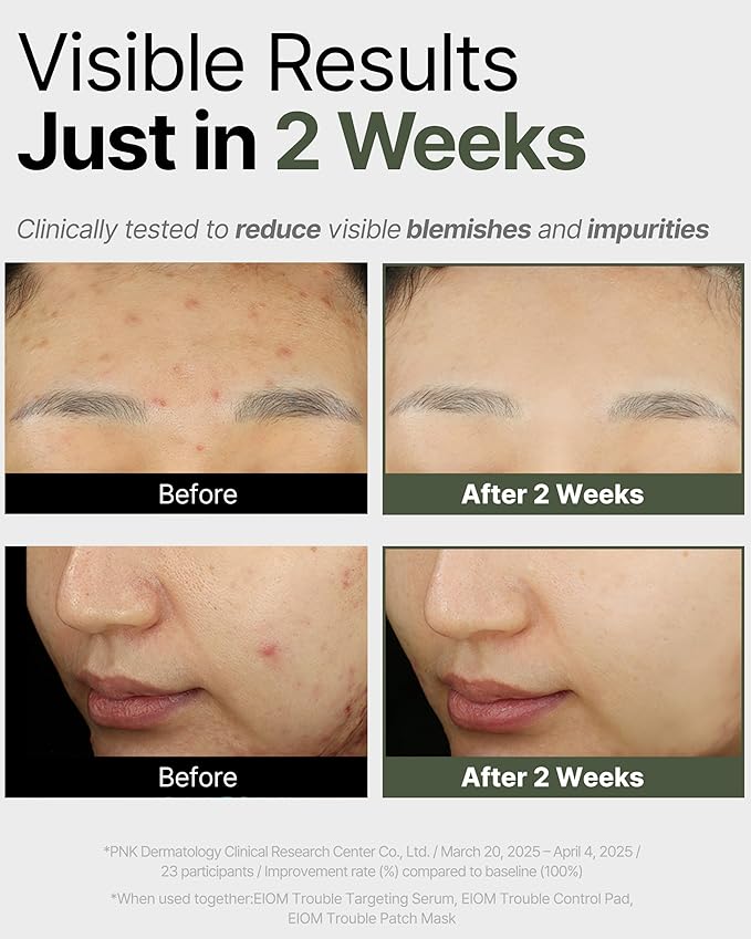 EIOM Trouble Patch Mask – Full Face Sheet Mask for Acne-Prone Skin | Sebum-Absorbing Oil Control, Pore Purifying, Tea Tree Biome, Korean Skincare Acne Face Mask, Hydrocolloid-Infused Sheet (20ml x 4)