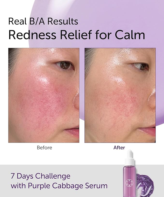 SERUMKIND Purple Cabbage Drop Serum, Soothing & Comfort Care, Red Cabbage Extract, Beta-Glucan, Korean Skincare (1.01 fl oz / 30 ml)