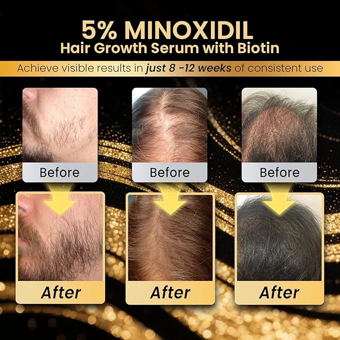 Koi Beauty 5% Minoxidil for Men & Women Hair Growth, Beard Growth, Hair Loss Treatment, Unisex Adult, Unscented Serum with Biotin - 60ml/2.02oz