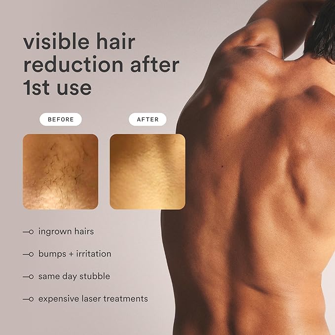 Nood™ Flasher Pro — Forbes Best Product 2026 — IPL Laser Hair Removal Device For At Home Use — Pain-Free, Permanent, Visible Results After First Use & Works Everywhere Hair Grows — Gloss White