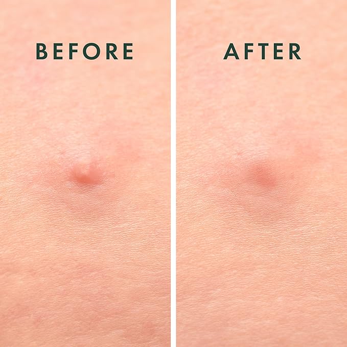 Rael Miracle Microcrystal Spot Cover Hydrocolloid Pimple Patches (27 Ct)