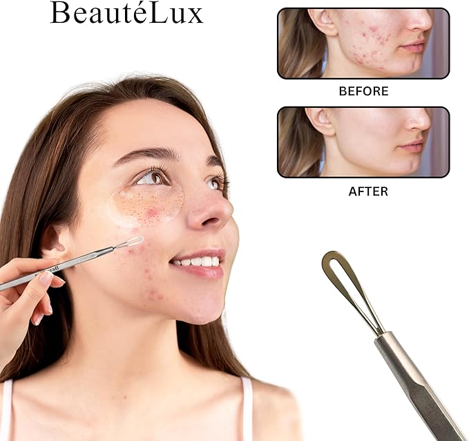 BeautéLux 2-in-1 Blackhead Removal Tool, Stainless Steel Acne Extractor, Blackhead & Whitehead Remover for Face/Nose, Dual-Loop Pimple Extractor, Skin Blemish Tool