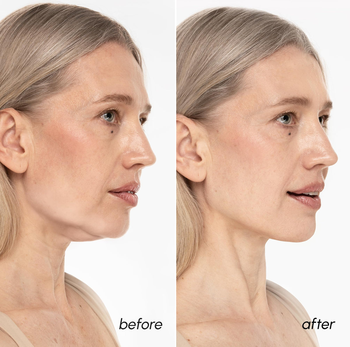 MAREE V Line Lifting Mask with 24K Gold – Deep Collagen Face Mask for Women – Jawline Shaper Mask with Retinol & Hyaluronic Acid – Neck Tightening & Firming - Double Chin Strap for Face Lift