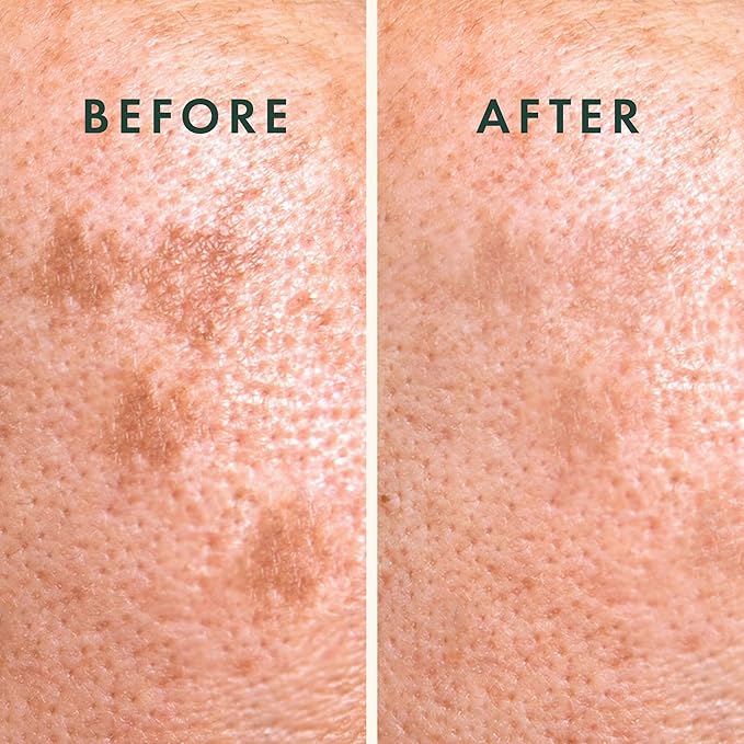 Rael Miracle Microcrystal Vitamin C Dark Spot Cover Pimple Patches (9 Ct)