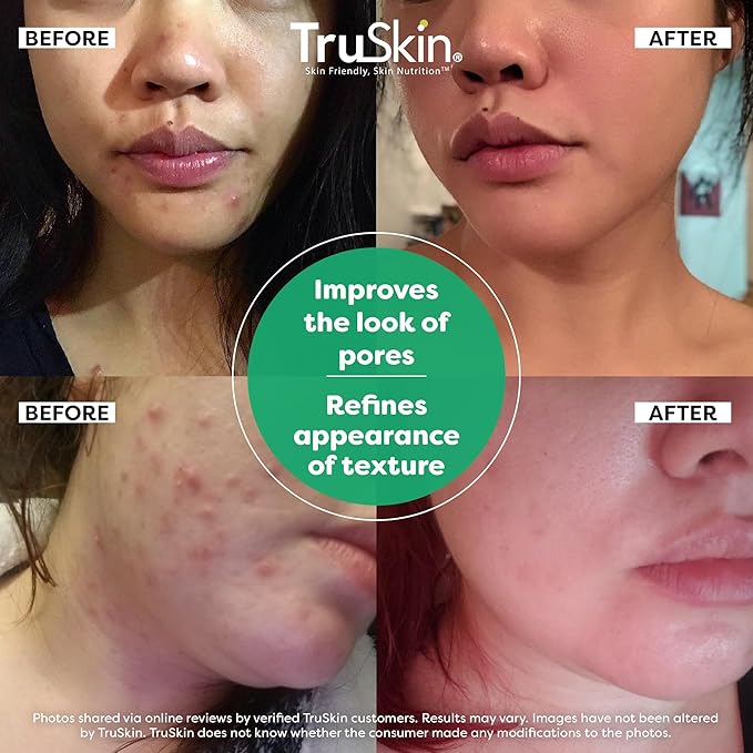 TruSkin Tea Tree Acne Serum with Salicylic Acid & Retinol, 2 fl oz