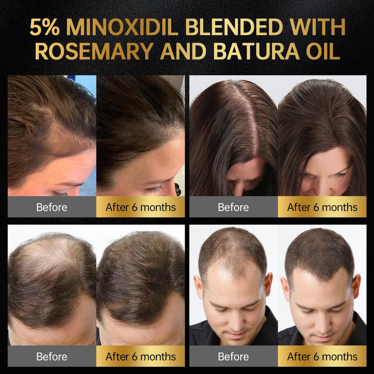 Minoxidil for Men & Women, With Biotin, Batana Oil, Rosemary Essential Oil, Effective Hair Loss Solution, Hair Loss Treatment for Hair Regrowth, Non-Greasy 5% Minoxidil - 60ml(Single Bottle Serum)