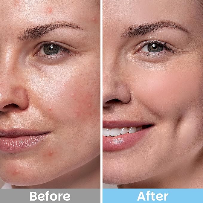 Kestper Salicylic Acid Exfoliating Facial Pads for Blemish-Prone Skin