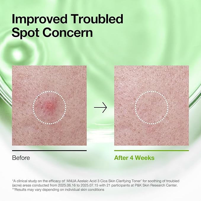 Anua Azelaic Acid 3 CICA Clarifying Toner, Daily Exfoliating Facial Toner with Salicylic, for Soothing & Skin Clarity, Sebum & Spot Care, Suitable for Sensitive Skin, Korean Skincare, 8.45 fl.oz.