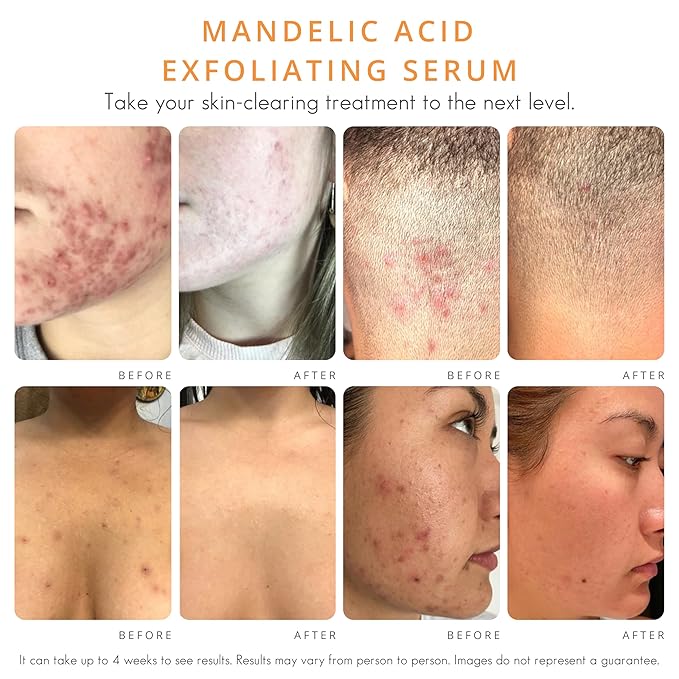 Almond Clear Mandelic Acid Face & Body Clearing Serum, Level 1- for acne, folliculitis, aging skin, ingrown hairs, dark spots - face, chest, butt, back, thighs, arms - 1 fl oz