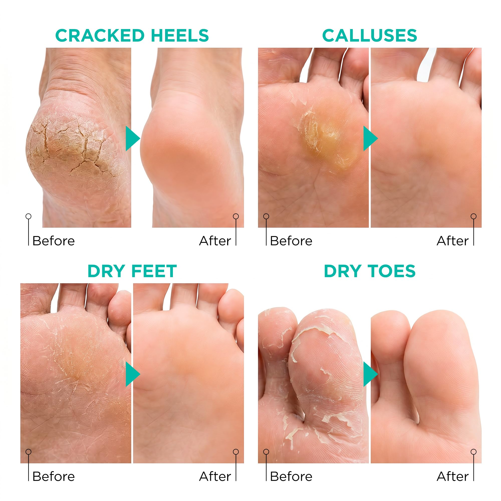Lavinso Foot Peel Mask for Dry Cracked Feet – 2 Pack Peeling Mask Removes Dead Skin and Calluses - Exfoliating for Soft Baby Feet, Original Scent