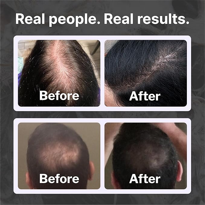 Shapiro MD Hair Growth Experts DHT Fighting Hair Loss Shampoo, 1 Month