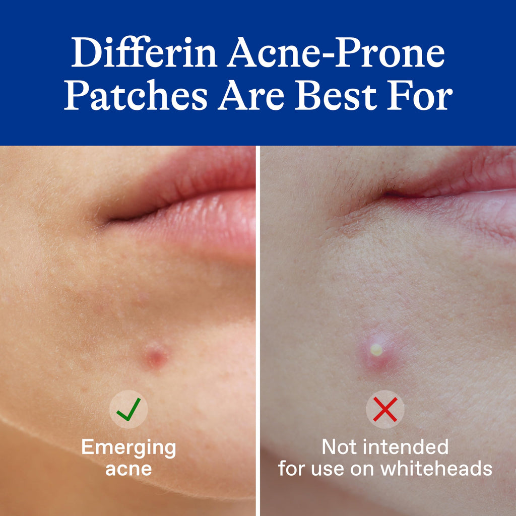 Differin Acne Treatment Pimple Patches, Salicylic Acid & Centella, 36 ct