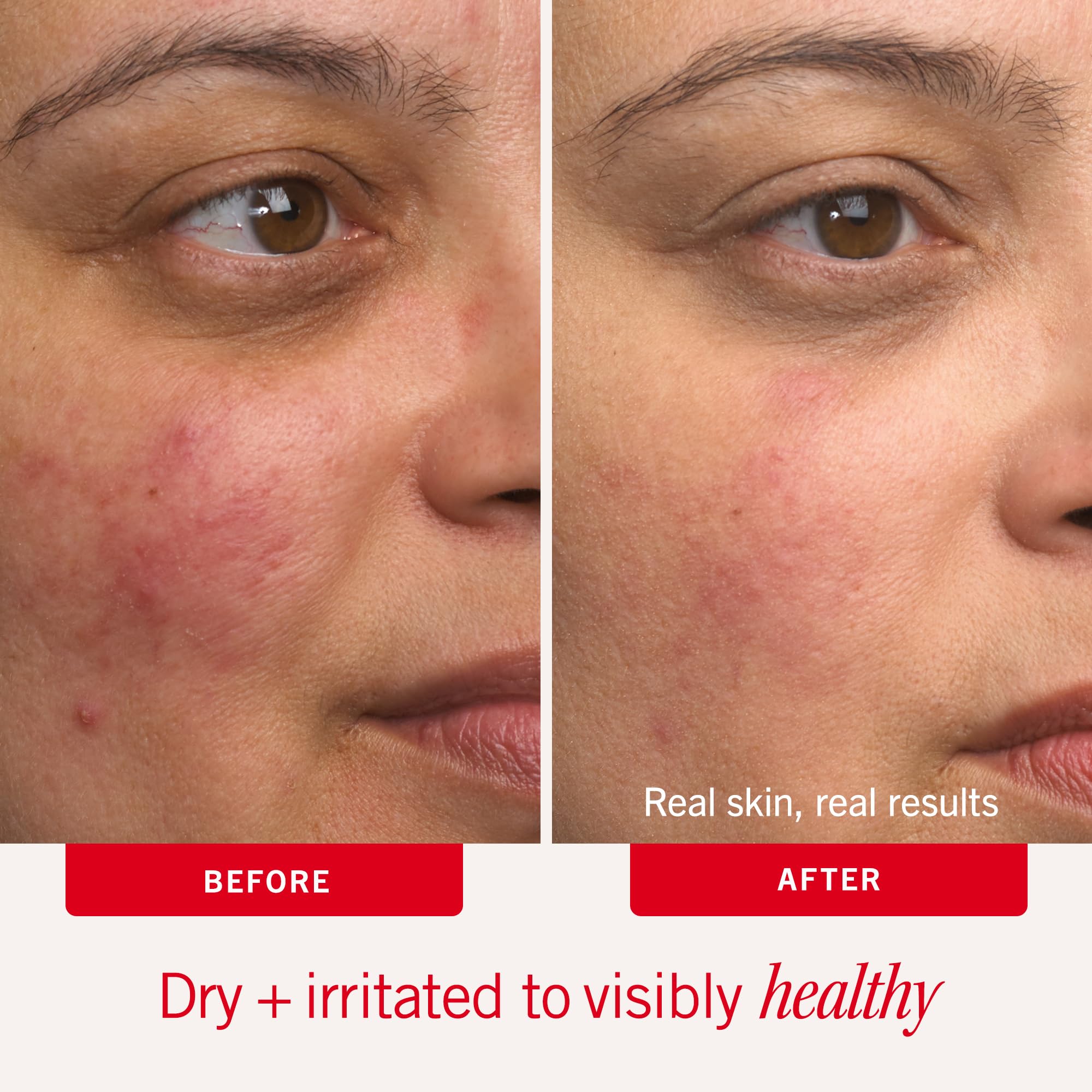 First Aid Beauty Ultra Repair Cream, Intense Hydration - Clinically Tested Face & Body Moisturizer with Colloidal Oatmeal - Supports Eczema & Dry Skin Barrier Repair - Fragrance Free - 2 oz