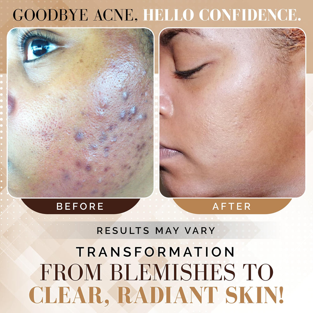 Noir D'or Acne Scar Treatment, Hyperpigmentation Treatment for Face, Normal to Oily Acne Skincare | Three Step Scar Repair Set for Acne Scars and Dark Spot Remover | Breakout Acne Treatment for Scars