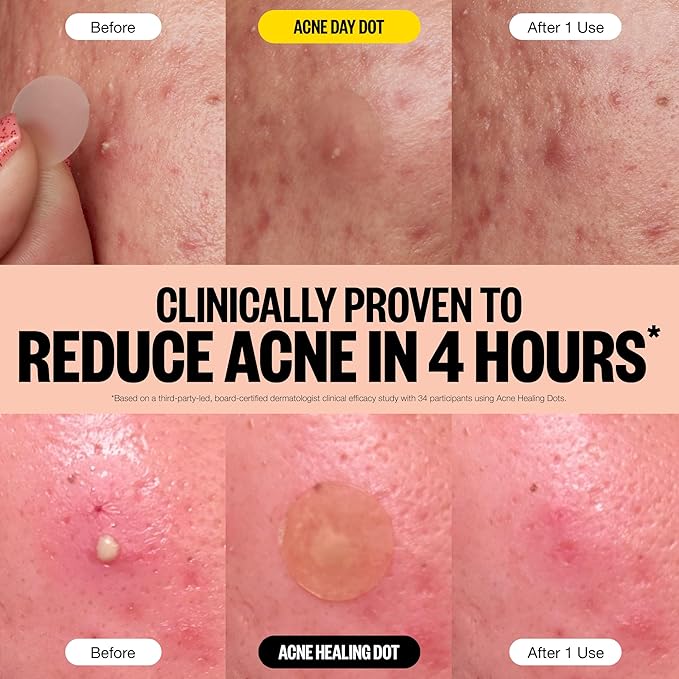 PEACE OUT Acne Day & Night Duo Hydrocolloid Pimple Patches (20 count)