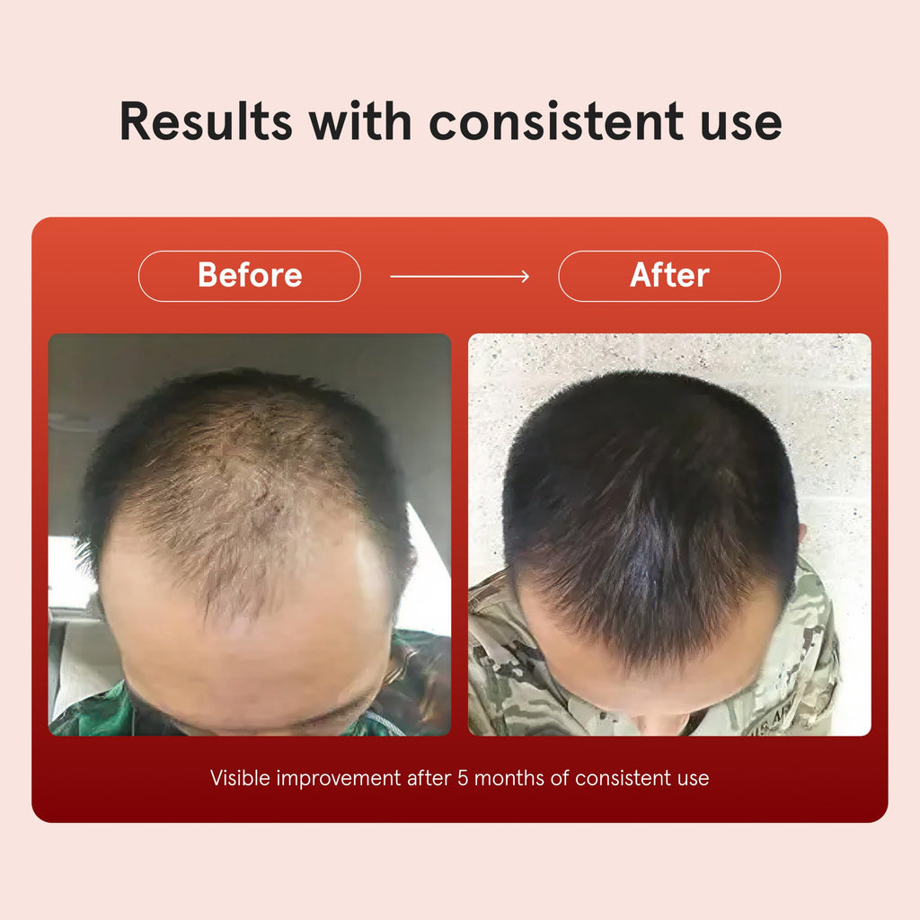 Keeps Minoxidil Solution 5% for Men, 3 Month Supply (3 x 2 fl oz Bottles)