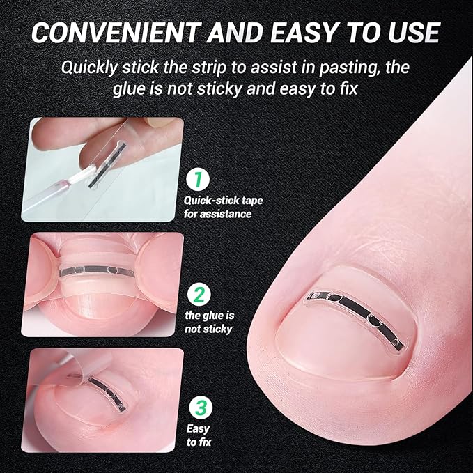Reieset Titanium Alloy Ingrown Toenail Treatment, Nail Tools, and Ingrown Toenail Removal Kit Specially Designed for Curved Nail Repair and Ingrown Toenail Corrector (0.59/0.67in)
