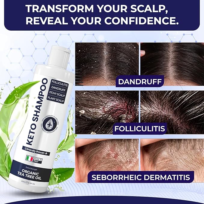 Psoriasis Shampoo Anti Dandruff - Medicated Shampoo for Dandruff, Flakes, Seborrheic Dermatitis & Folliculitis Treatment - Anti Fungal Solution for Itchy, Flaky & Dry Scalp - 200ml (Pack of 2)