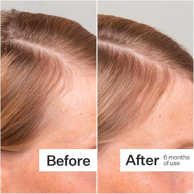 Act+ Acre, Mini Stem Cell Scalp Serum, Reduces Shedding, 3pk