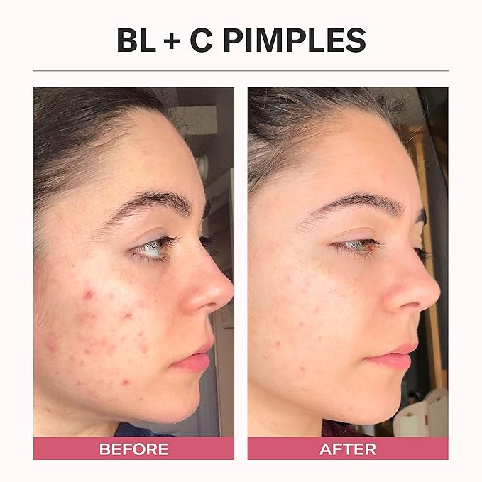 Odacité Bl+C Serum Concentrate for Face, Luxury Black Cumin + Cajeput Pore-Clearing Facial Oil for Pimples & Blemishes, Vegan Vitamin E Spot Treatment for Oily, Acne-Prone Skin, 0.17 fl oz