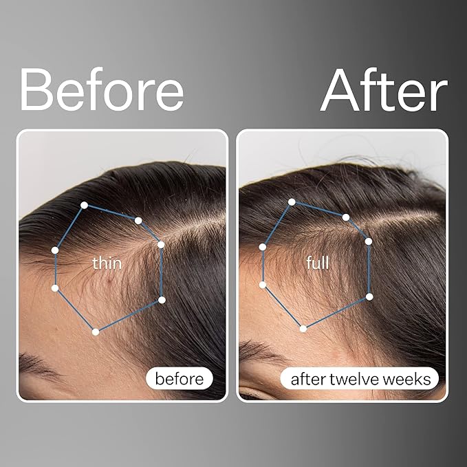 Act+ Acre, Stem Cell Scalp Serum, Reduces Shedding, 1 fl oz
