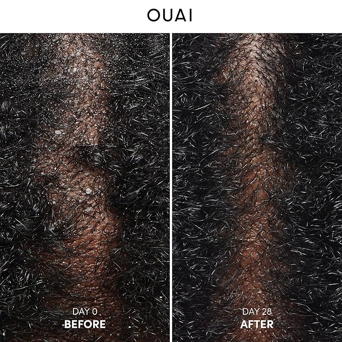OUAI Anti Dandruff Shampoo - Soothing Salicylic Acid Shampoo for Flaky, Dry and Itchy Scalp - Reduces Itching, Redness and Irritation - Sulfate Free Scalp Care (10 Fl Oz)
